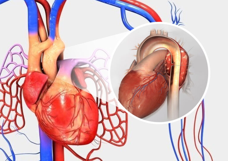 Aneurisma de aorta, doença grave e pouco conhecida, Prof. Dr. Sthefano Atique Gabriel