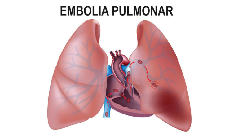 Por que a embolia pulmonar é tão grave e pode ser fatal ? Por Prof. Dr. Sthefano Atique Gabriel